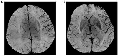 Diffusion- and Susceptibility Weighted Imaging Mismatch Correlates With Collateral Circulation and Prognosis After Middle Cerebral Artery M1-Segment Occlusion